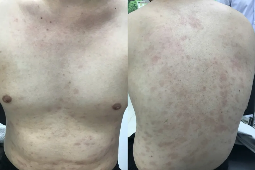 ca bệnh giang mai - 1