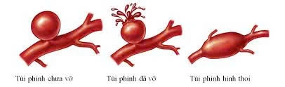 Phình mạch não là tình trạng phình to hoặc phồng lên của một mạch máu trong não. Ảnh: Internet Phình mạch não