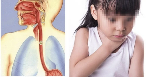 Khi phát hiện trẻ hóc dị vật không nên tìm cách lấy dị vật vì có thể đẩy vào sâu hơn. Ảnh: Internet hóc dị vật