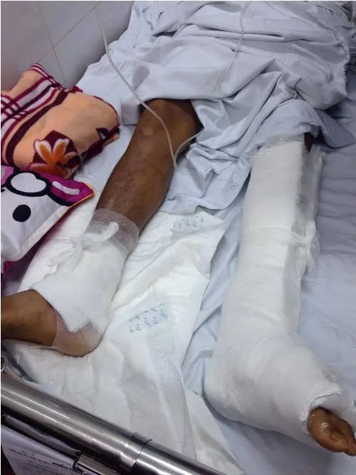 Bệnh nhân bị mổ nhầm chân