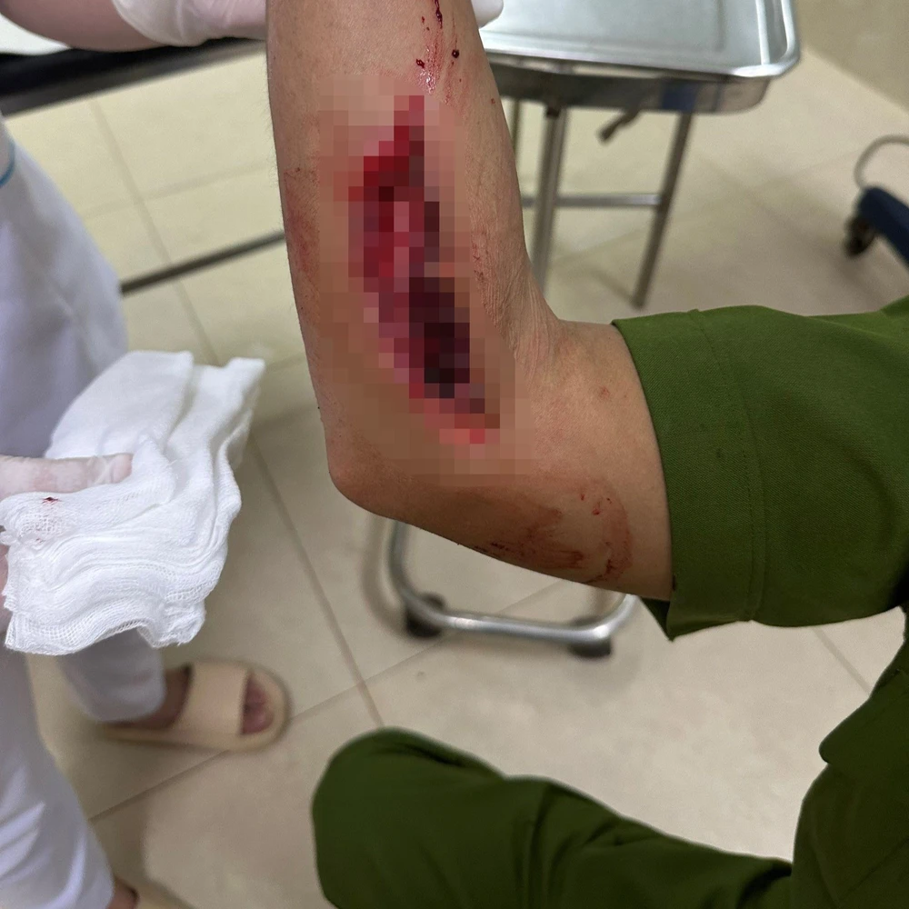 Trung tá Nguyễn Đắc Thủy bị tông rách bắp tay. Ảnh: NDCC