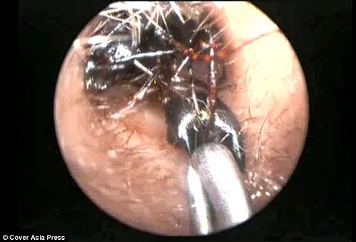 ổ kiến trong tai bé gái 12 tuổi