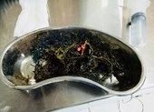 Phát hoảng vì bệnh nhân có 1 kg gỗ, nhựa trong người