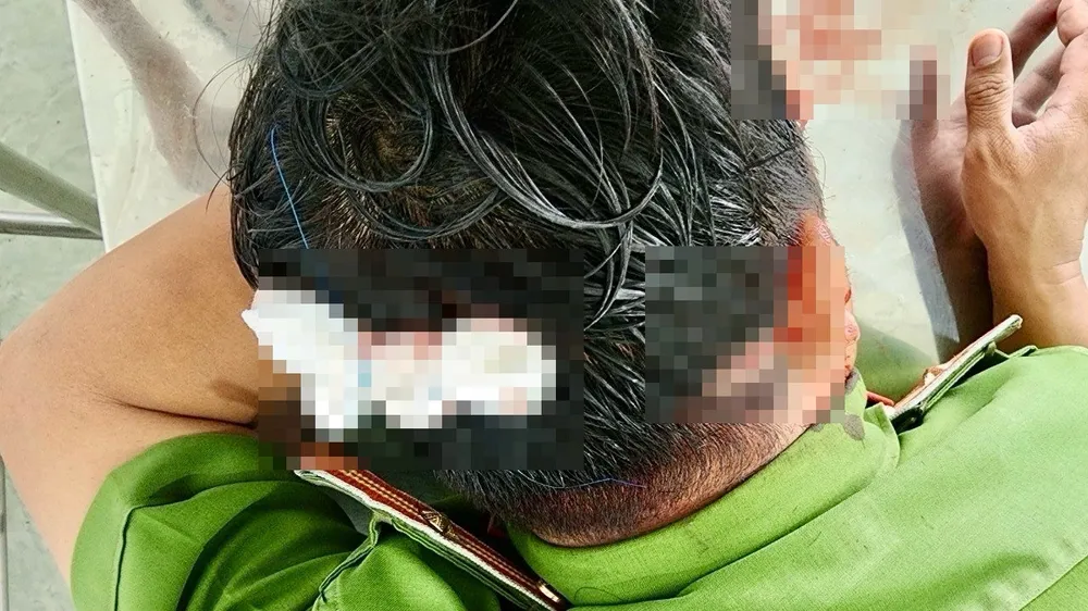 Trong quá trình truy bắt, một chiến sĩ công an bị Mạnh dùng dao chém bị thương vùng đầu. Ảnh: HOÀNG HỮU chem-cong-an-1.jpg