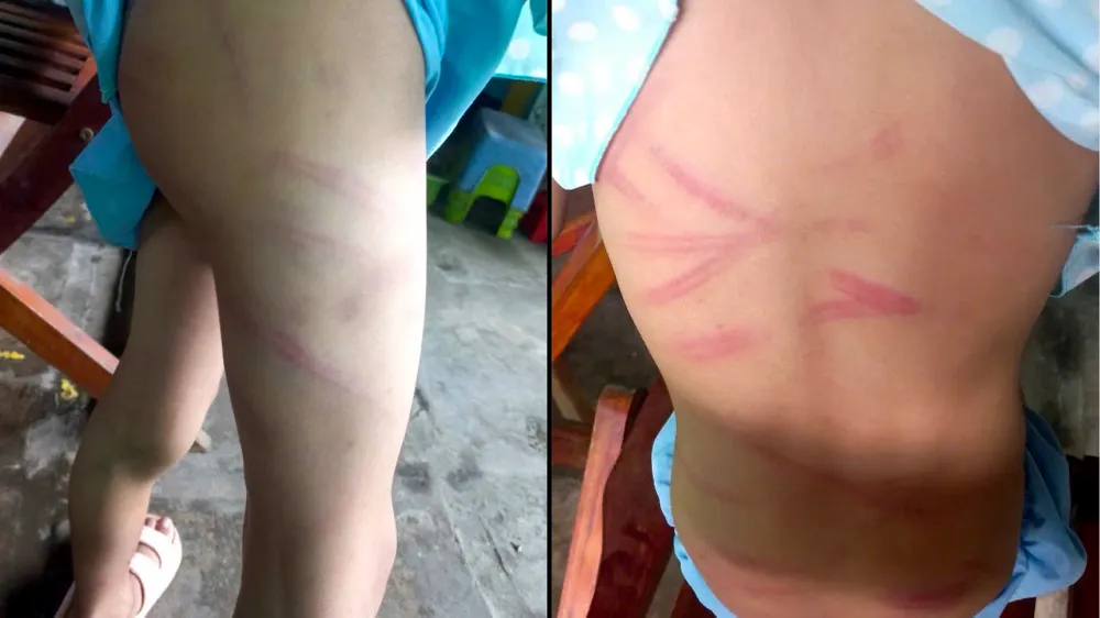 Trên người của cháu T có nhiều vết thương cũ, mới đan xen do bị mẹ đánh. Ảnh: TT Vụ mẹ đánh con ở xã Vị Tân