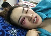 1 thanh niên đánh cô gái trong quán bánh xèo nhập viện
