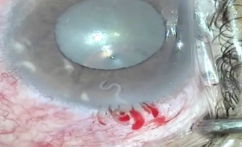 Kỳ lạ: Con giun đũa chó sống trong mắt người phụ nữ ảnh 1