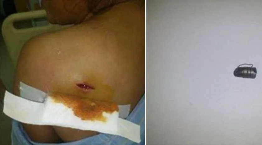 Đầu đạn (bên phải) được phẫu thuật gắp ra từ người bà Nguyễn Thị Tý.