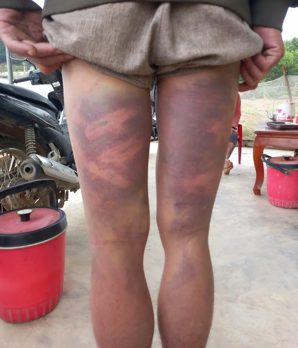 Vết bầm tụ máu ở chân anh Bang. Ảnh gia đình cung cấp.
