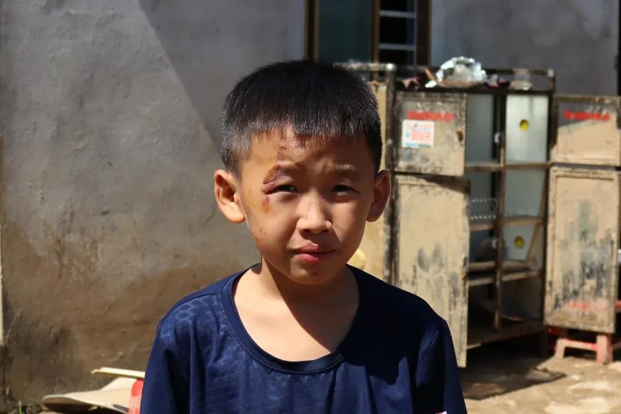 Trên mặt, chân, tay của cháu Mùa có nhiều vết thương do lũ cuốn trôi, chưa lành. Ảnh: ĐẮC LAM Trên mặt, chân, tay của cháu Mùa có nhiều vết thương do lũ cuốn trôi, chưa lành. Ảnh: ĐẮC LAM