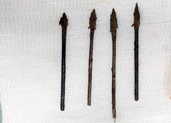 Bốn mũi tên đã được cắt ngắn và đưa ra khỏi vùng mặt em P. Ảnh: BV Sản nhi Nghệ An. Bốn mũi tên đã được cắt ngắn và đưa ra khỏi vùng mặt em P. Ảnh: BV Sản nhi Nghệ An.