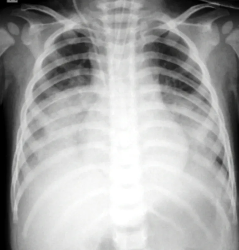 Uống nhầm dầu thắp đèn