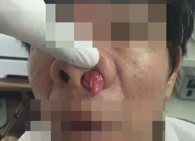 Lấy khối u 'thập thò' trong mũi bệnh nhân ảnh 1 Lấy khối u 'thập thò' trong mũi bệnh nhân ảnh 1