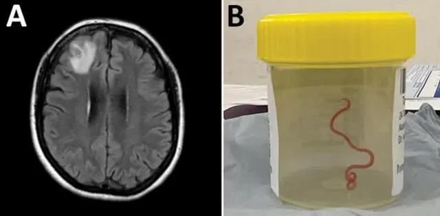 Con giun được các bác sĩ Úc lấy ra từ não của một bệnh nhân 64 tuổi. Ảnh: EMERGING INFECTIOUS DISEASES