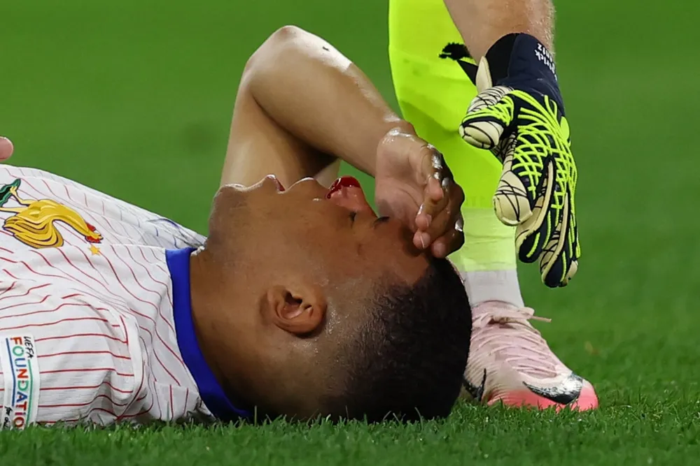 Mbappe bị chấn thương mũi khiến phải rời sân. Ảnh: GETTY. đội tuyển Pháp
