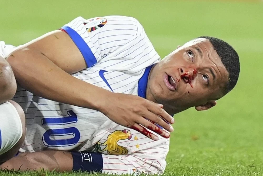 Mbappe bị gãy mũi gây chảy máu khiến anh phải nhập viện. Ảnh: GETTY. Mbappe bị gãy mũi