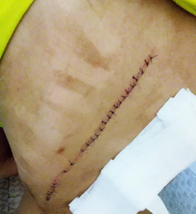 Hoang mang: Lại tái diễn rạch người nghiêm trọng ảnh 1 Vết thương trên lưng chị Trang.