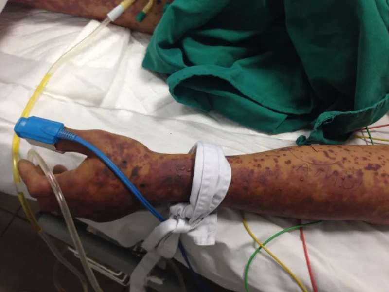 Xin về nhà chờ chết vì dính liên cầu khuẩn do ăn tiết canh lợn 2