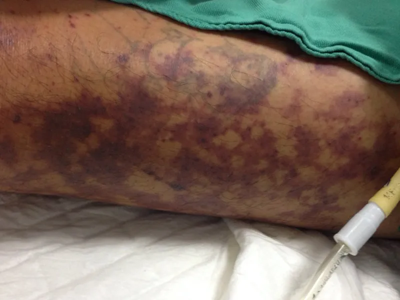 Xin về nhà chờ chết vì dính liên cầu khuẩn do ăn tiết canh lợn 3