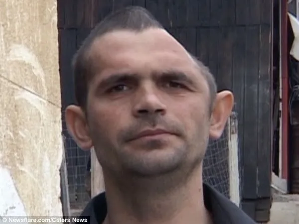 Tái tạo hộp sọ thành công cho người đàn ông mất gần nửa đầu ảnh 2