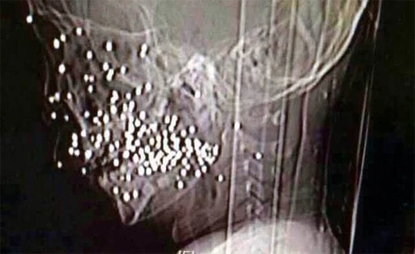 Cậu bé may mắn thoát chết dù bị 86 viên đạn găm vào mặt ảnh 1