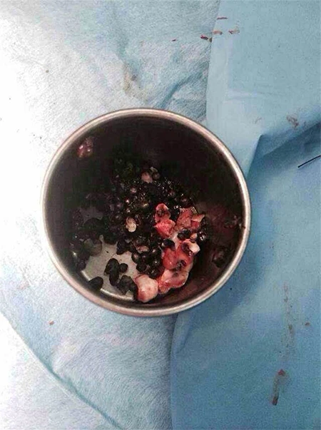 Cậu bé may mắn thoát chết dù bị 86 viên đạn găm vào mặt ảnh 2