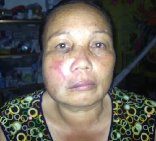 Khuôn mặt của bà Sâm bị ông Phát đánh thâm đen, biến dạng. Ảnh gia đình cung cấp