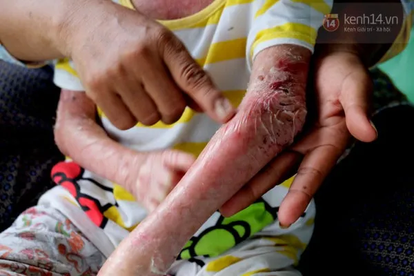 Sự thật câu chuyện bé gái 'bị tạt nước sôi gây lở loét để bắt đi ăn xin' ảnh 3