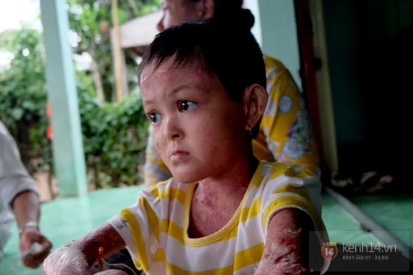 Sự thật câu chuyện bé gái 'bị tạt nước sôi gây lở loét để bắt đi ăn xin' ảnh 7
