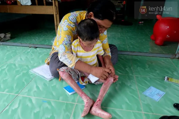 Sự thật câu chuyện bé gái 'bị tạt nước sôi gây lở loét để bắt đi ăn xin' ảnh 2