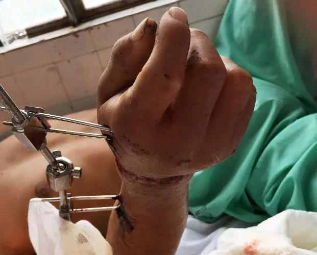 Bàn tay phải của bệnh nhân T đã được nối thành công. Ảnh: TRẦN NGỌC