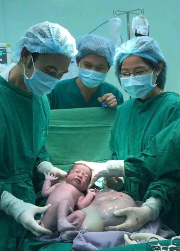 Kỳ diệu bé gái song sinh chào đời vẫn trong bọc ối ảnh 1