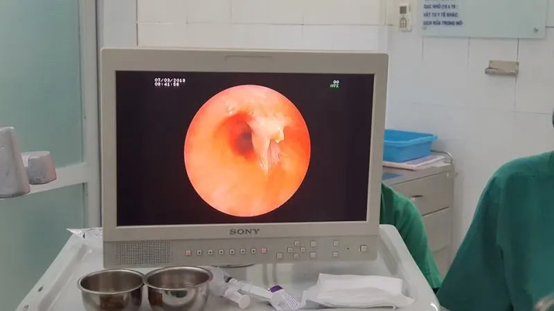 Ho suốt ba năm trời mới phát hiện bị mắc xương cá ảnh 1 Ho suốt ba năm trời mới phát hiện bị mắc xương cá ảnh 1