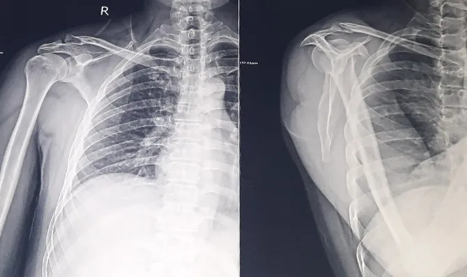 Sau khi chụp X-Quang, bác sĩ kết luận anh D bị gãy xương đòn vai. Ảnh: ĐT Sau khi chụp X-Quang, bác sĩ kết luận anh D bị gãy xương đòn vai. Ảnh: ĐT