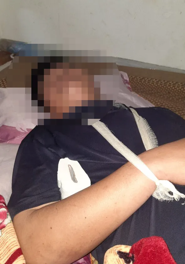 Anh Bùi Văn D (SN 1983) bị ngã, gãy xương đòn cánh tay sau khi hút thuốc lào buổi sáng. Ảnh: ĐT Anh Bùi Văn D (SN 1983) bị ngã, gãy xương đòn cánh tay sau khi hút thuốc lào buổi sáng. Ảnh: ĐT