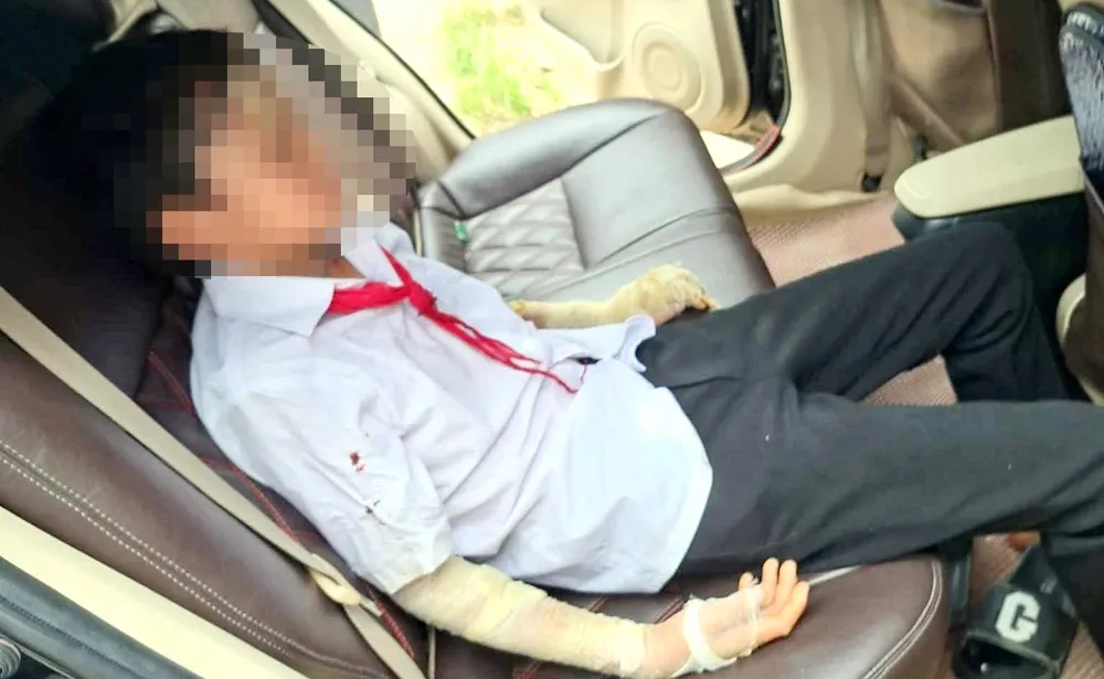 Nguyên nhân vụ nổ bóng bay khiến 10 học sinh bị thương do thầy giáo hút thuốc đi qua không may quệt phải. Ảnh: NDCC