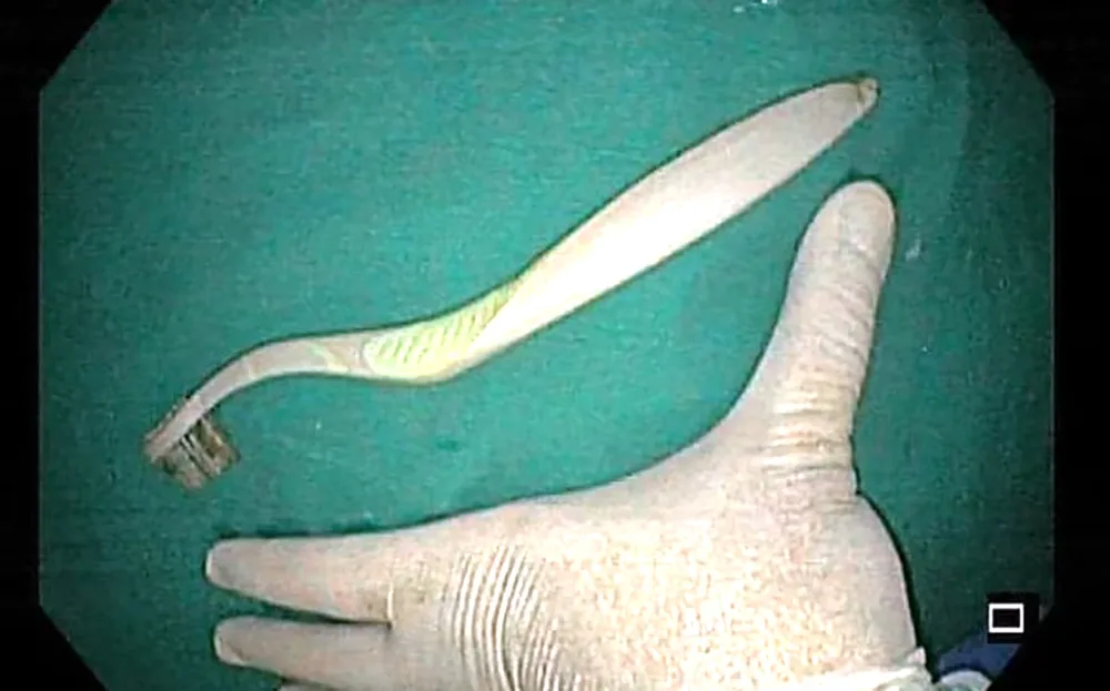 Bàn chải đánh răng dài 20cm được bác sĩ Bệnh viện Đa khoa tỉnh Thanh Hóa sử dụng thủ thuật nội soi gắp từ trong dạ dày của nữ sinh viên ra ngoài. Ảnh: BVĐK