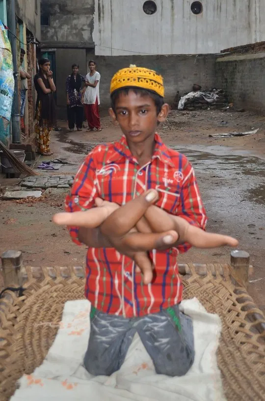 Cậu bé có đôi bàn tay khổng lồ ảnh 6