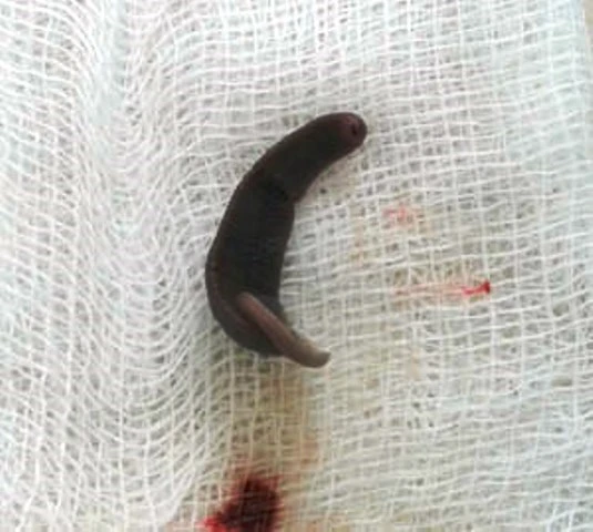 Con vắt dài 4cm sống hơn 10 ngày trong mũi bệnh nhi ở Hà Giang ảnh 1