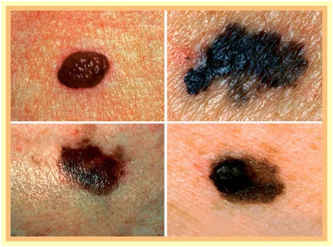 15 dấu hiệu ung thư đàn ông dễ bỏ qua ảnh 4