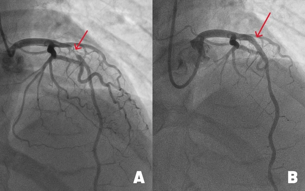Hình ảnh động mạch liên thất trước (mạch máu chính nuôi tim) bị đứt do tắc nghẽn nặng (hình A) và sau khi được tái thông nhờ đặt stent kích thước lớn. Ảnh: BVĐK Tâm Anh