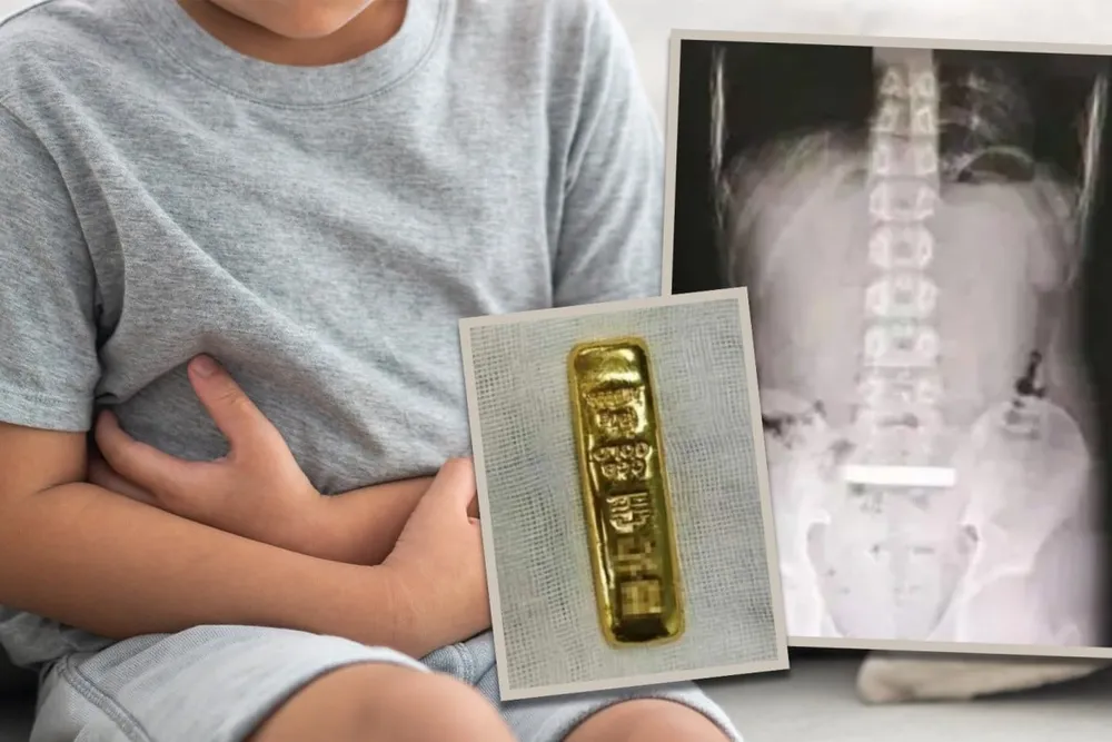 Bé trai nhập viện phẫu thuật vì nuốt thỏi vàng 100 gram. Ảnh: SOUTH CHINA MORNING POST nuốt thỏi vàng