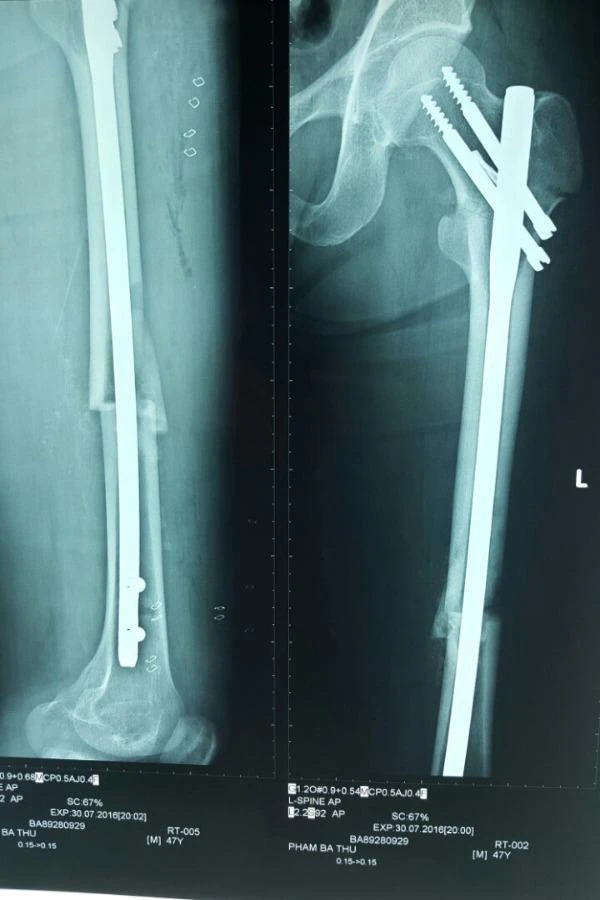 Hai chân bệnh nhân lành lặn sau khi được đóng đinh nội tủy kín
