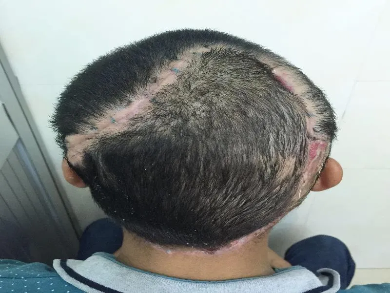 Sau sáu tuần điều trị, xương sọ bị lộ của anh P đã được che phủ và tóc mọc khá nhiều.