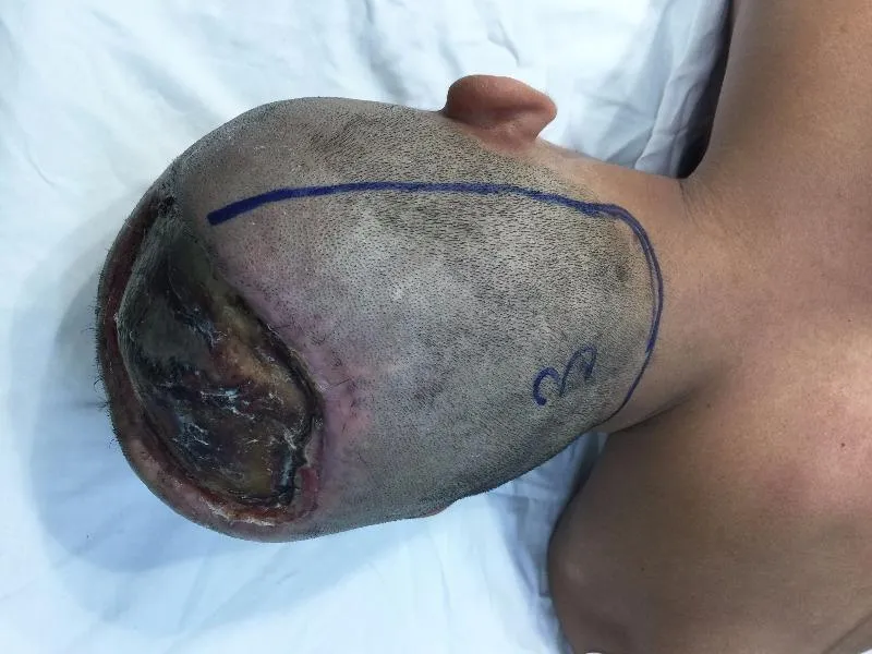 Bệnh nhân P bị mất da đầu, lộ cả xương sọ do bỏng điện.