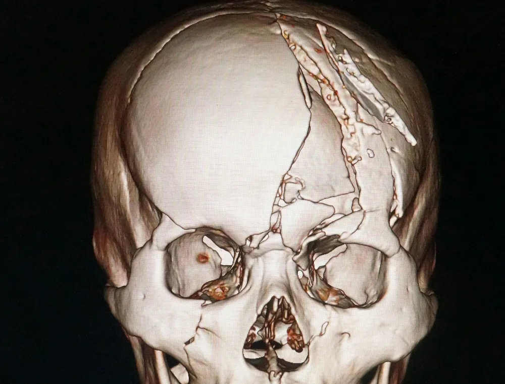 Cứu sống nạn nhân sọ vỡ nát nhiều mảnh ảnh 1 Cứu sống nạn nhân sọ vỡ nát nhiều mảnh ảnh 1