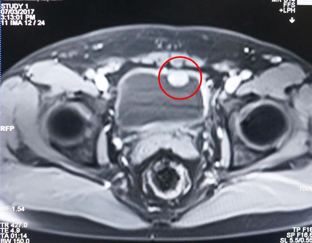 Kết quả chụp MRI cho thấy khối u xâm lấn qua lớp cơ bàng quang.