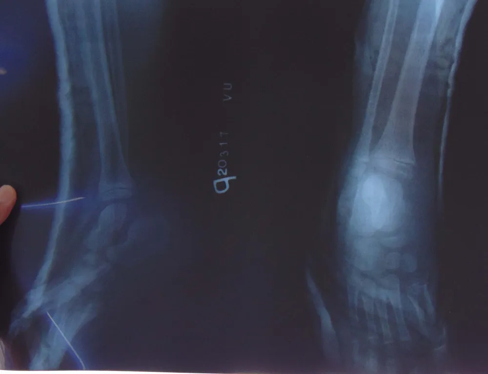 Rách da, gãy gót do kẹt chân vào căm xe máy ảnh 1 Rách da, gãy gót do kẹt chân vào căm xe máy ảnh 1