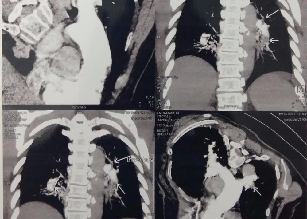 Hình ảnh huyết khối trong các nhánh động mạch phổi của bệnh nhân