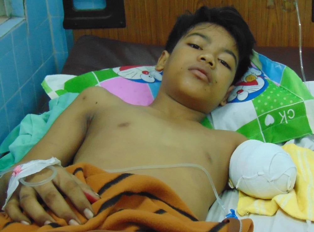 Tay trái bệnh nhân CK bị cắt cụt.